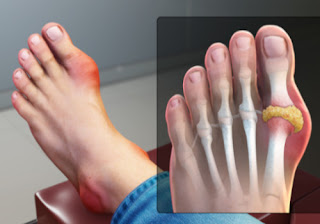 How to Control High Uric Acid
