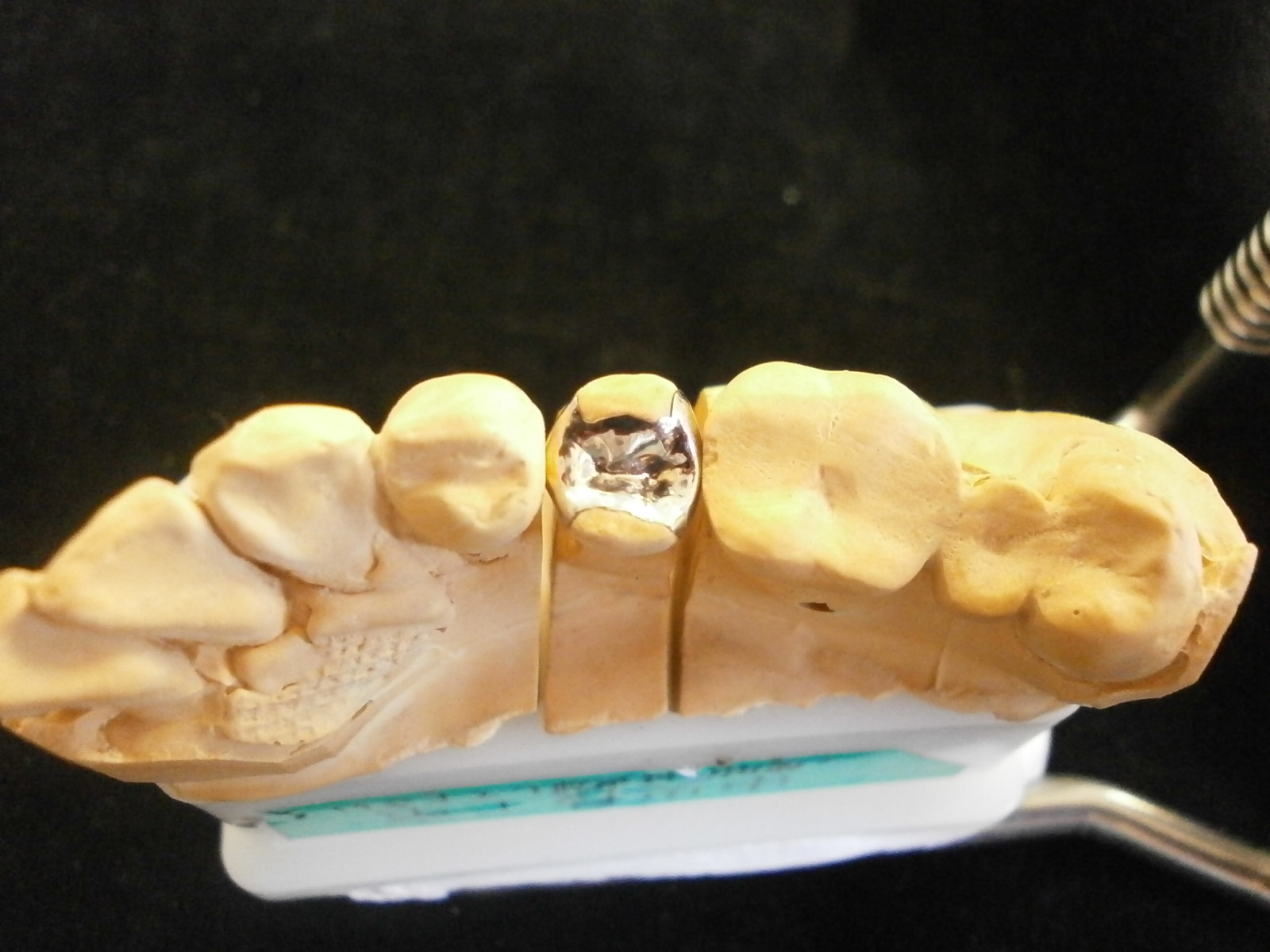 テーラーメイド歯科補綴修復物の紹介 Introduction of the tailor-maid dental prosthesis ...