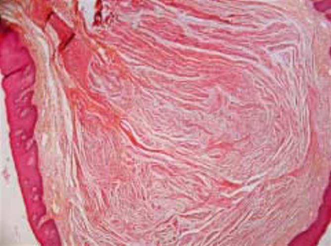 Pathologie de la muqueuse buccale