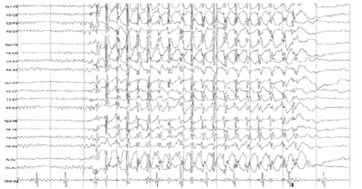 Classification and Management of Epilepsy