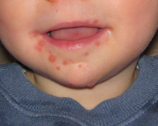 11 aylık erkek çocukta tipik ağız çevresi lezyonları