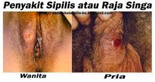 Penyakit Sipilis Atau Raja Singa