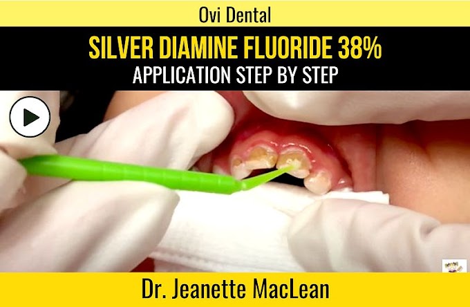 SDF: Silver Diamine Fluoride 38% - Application step by step - Dr. Jeanette MacLean