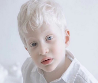 Albinism disease - Diseasezero
