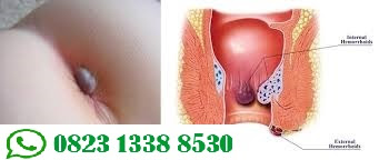 Cara Paling Ampuh Menghilangkan Benjolan Ambeien Keluar Dari Lubang Dubur https://sediaobatwasir.blogspot.com/2019/09/cara-paling-ampuh-menghilangkan.html