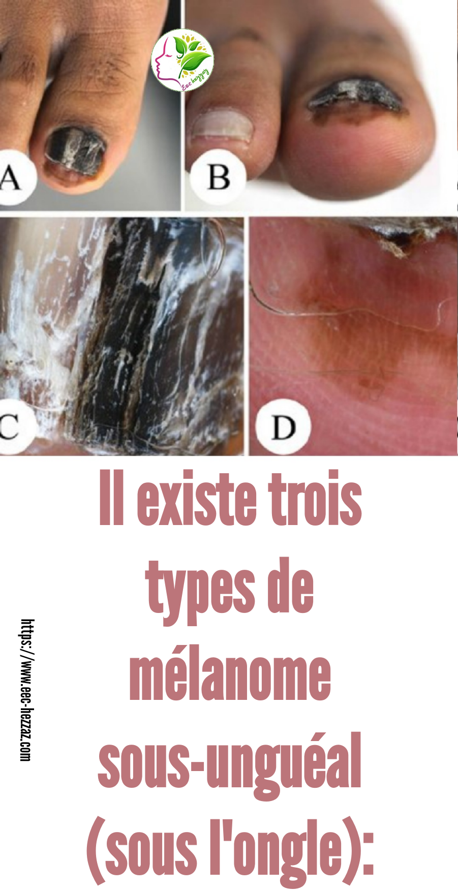 There are threeIl existe trois types de mélanome sous-unguéal (sous l'ongle):