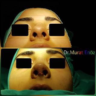 Micromotor Assisted Rhinoplasty, Nose Job Istanbul,Female Nose Aesthetic Turkey,