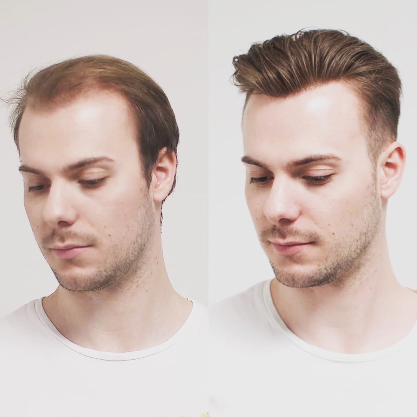 Non Surgical Vs Surgical Hair Replacement Which Is Best Best Hair Transplantation Dubai