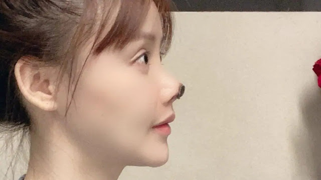 Chinese actress Gao Liu shares pictures of her decaying nose as she warns against the dangers of plastic surgery