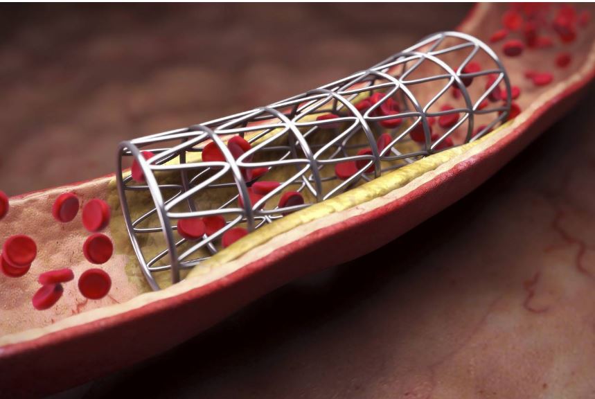 Cheap Pakistani made cardiac stents launched & prices revealed