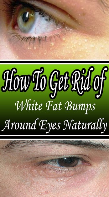 How To Get Rid Of Those White Spots Around Your Eyes Janeehealth