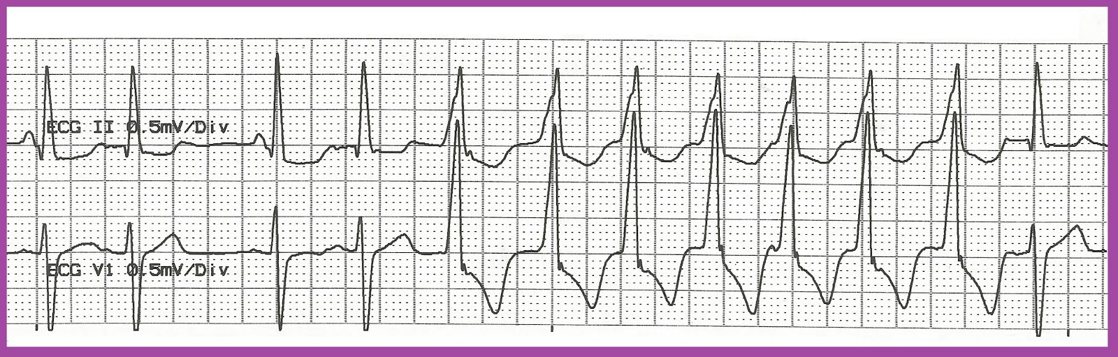 Practice EKG Rhythm Strips 187
