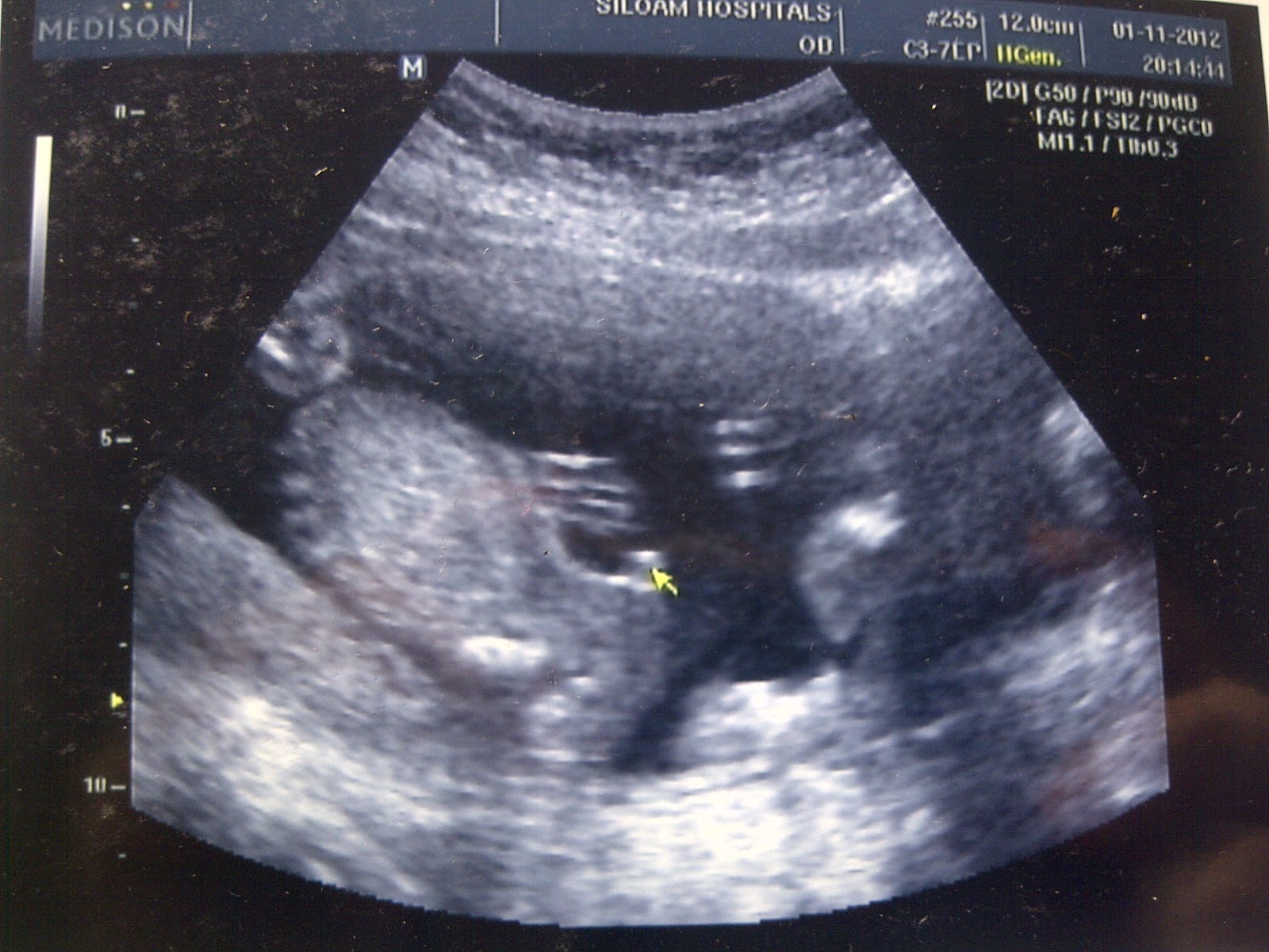 My Miracle Pregnancy