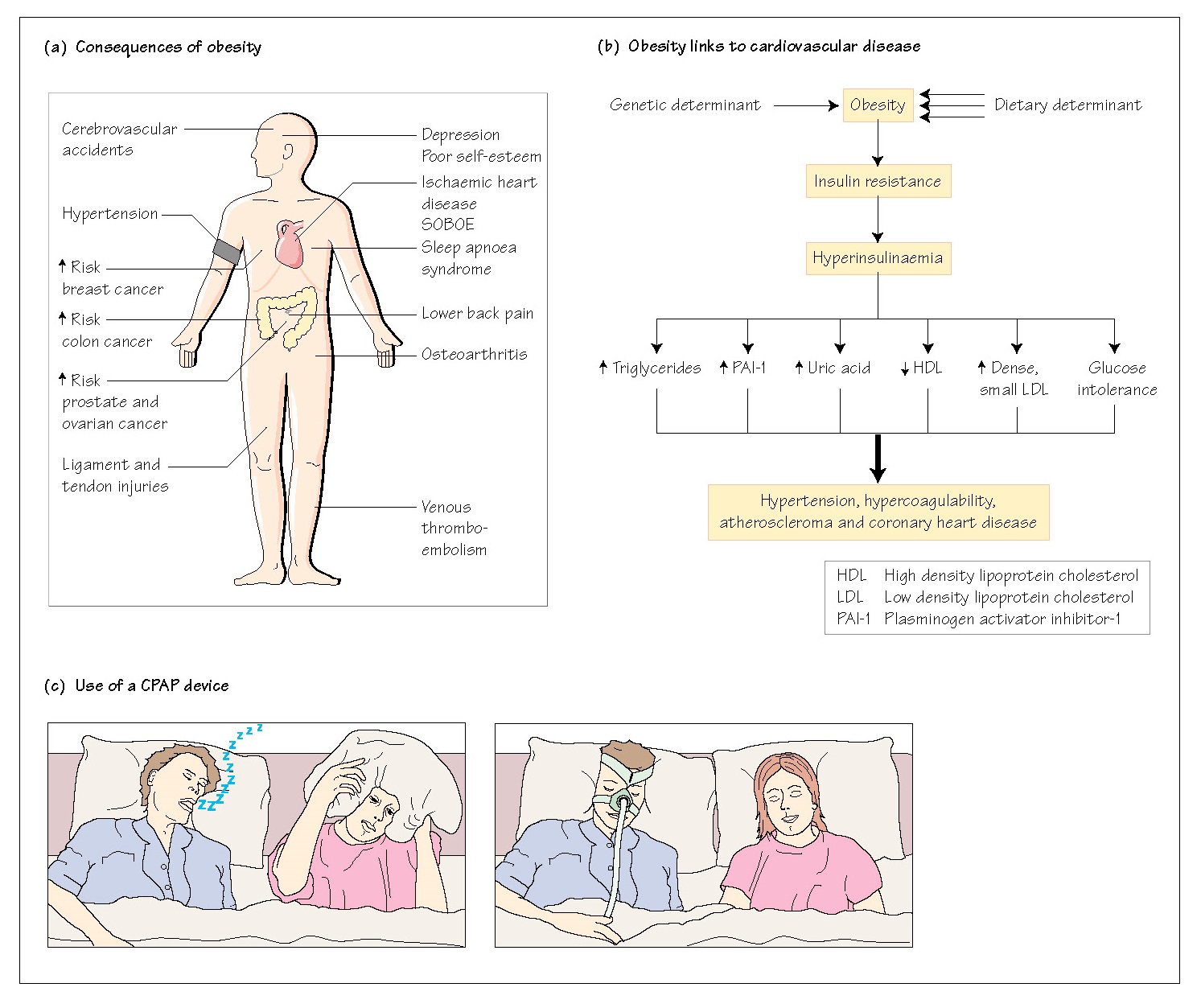Respiratory complications of obesity