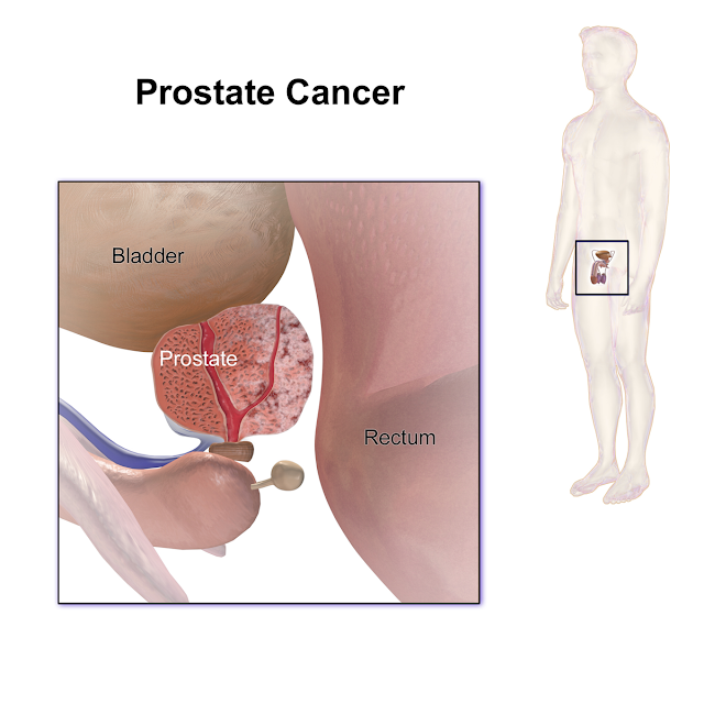  Advanced prostate cancer,symptoms,effects,teartment