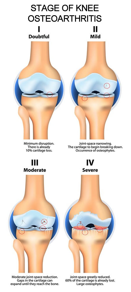 Stage of knee osteoarthritis