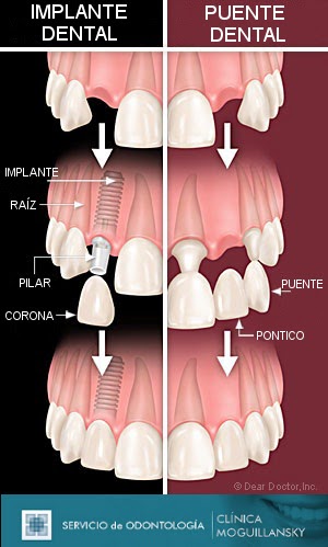 Odontolog A Cl Nica Moguillansky Implantes Dentales Y Rehabilitaci N