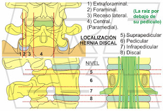 Localización anatómica hernia discal