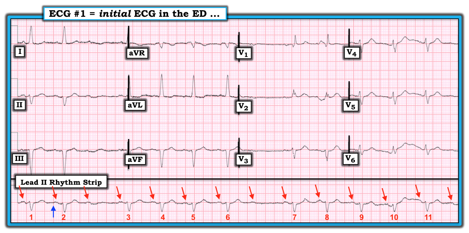 Dr. Smith's ECG Blog A Preoperative ECG on a patient with a hip fracture
