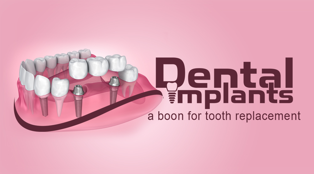 Dental Implants a boon for tooth replacement Richardson dental and craniofacial Hospitalposts