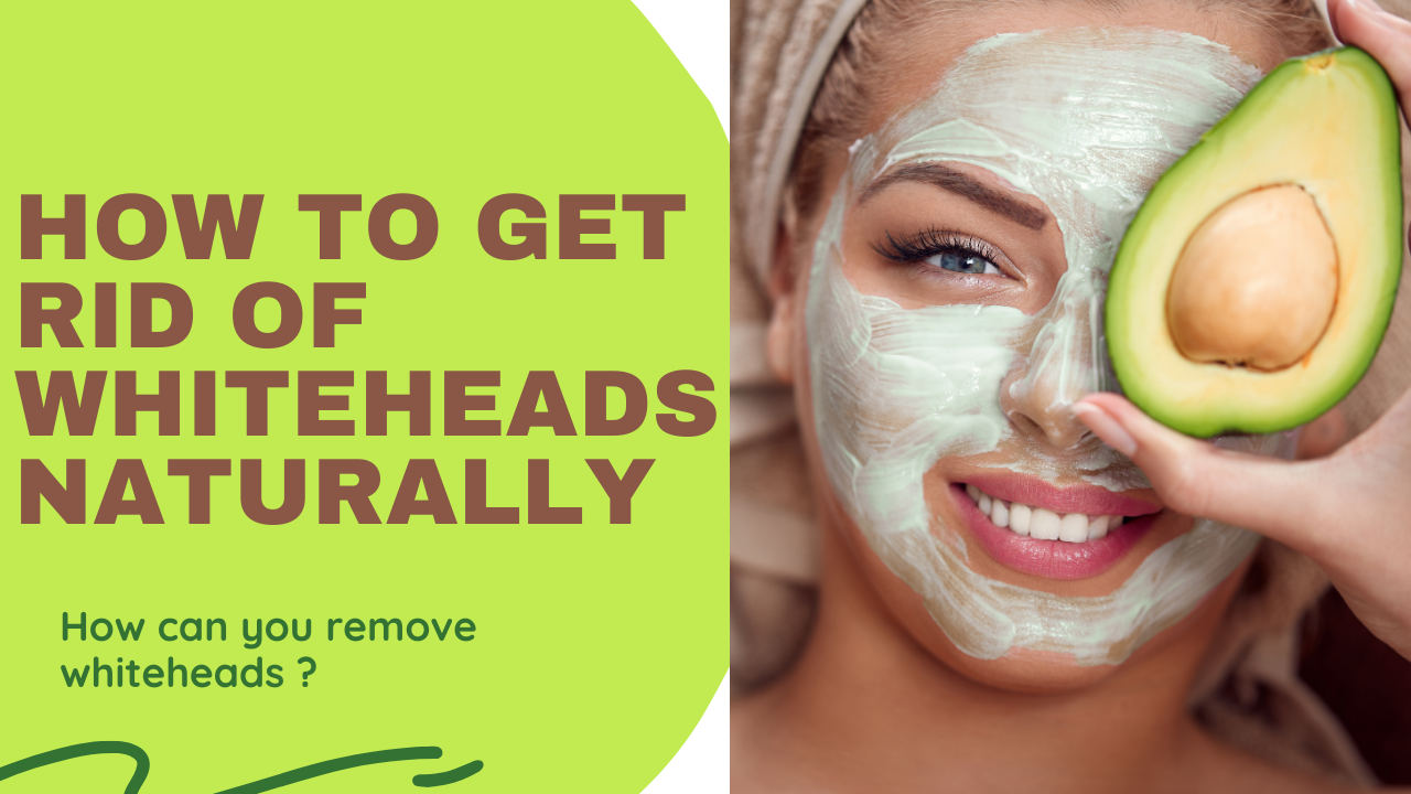 whiteheads-causes-how-to-get-rid-of-whiteheads-naturally-2020