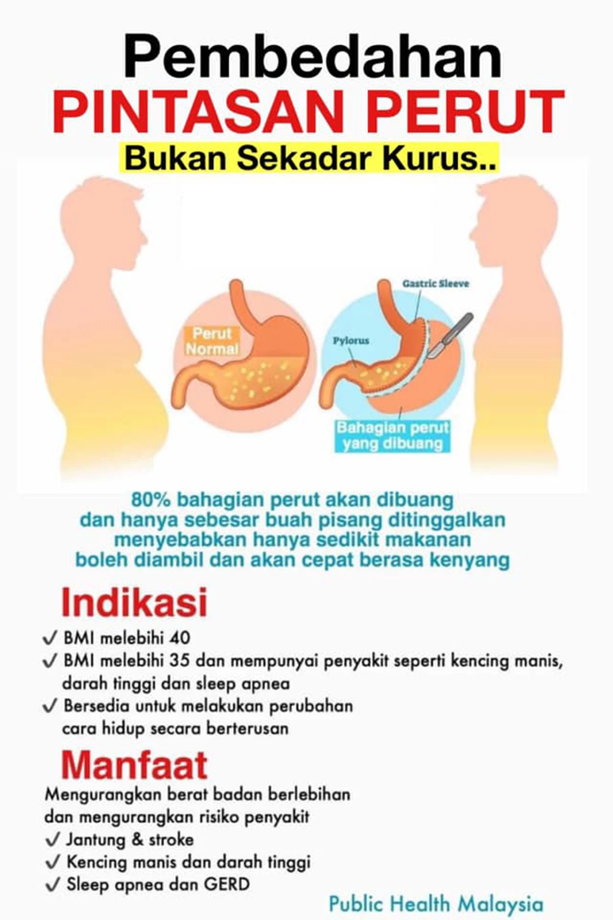 Pembedahan Bariatrik Potong Usus/Perut Cara Cepat Kurus