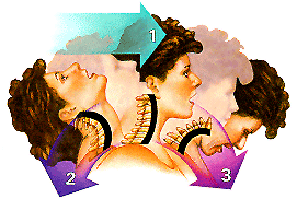 blog illustration of lady experiencing three stages of whiplash