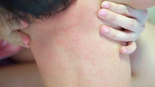 apa itu ruam pada bayi, apa obat ruam pada bayi, apakah ruam pada bayi bisa hilang, atasi ruam pada bayi, bedak untuk ruam pada bayi, berapa lama ruam pada bayi hilang, cara hilangkan ruam pada bayi, cara mengatasi ruam pada bayi, cara mengatasi ruam pada bayi akibat popok, cara menghilangkan ruam pada bayi, cara nak hilangkan ruam pada bayi, cara nak menghilangkan ruam pada bayi, cara obati ruam pada bayi, ciri ruam pada bayi, ciri2 ruam pada bayi, contoh ruam pada bayi, cream ruam pada bayi, cream ruam pada leher bayi, cream untuk ruam pada bayi, elak ruam pada bayi, foto ruam popok pada bayi, gambar ruam campak pada bayi, gambar ruam pada bayi, gambar ruam popok pada bayi, gambar ruam popok pada bayi laki laki, gambar ruam popok pada bayi perempuan, jenis ruam pada bayi, jenis ruam popok pada bayi, jurnal ruam popok pada bayi, kapan ruam susu pada bayi hilang, krim untuk mengatasi ruam pada bayi, makanan yang menyebabkan ruam pada bayi, mengatasi gatal ruam pada bayi, mengatasi ruam pada bayi akibat pampers, mengatasi ruam pada bayi baru lahir, mengatasi ruam pada selangkangan bayi, mengatasi ruam pada wajah bayi, mengobati ruam pada bayi secara alami, obat alami untuk ruam pada bayi, obat buat ruam pada bayi, obat gatal ruam pada bayi, obat herbal ruam pada bayi, obat ruam jamur pada bayi, obat ruam pada bayi, obat ruam pada bayi alami, obat ruam pada bayi baru lahir, obat ruam pada bayi di leher, obat ruam pada muka bayi, obat ruam popok pada bayi yang ampuh, obat untuk ruam pada bayi, penyebab ruam pada wajah bayi, petua hilangkan ruam pada bayi, ruam alergi pada bayi, ruam asi pada bayi, ruam campak pada bayi, ruam di bibir bayi, ruam di hidung bayi, ruam di jidat bayi, ruam di kepala bayi selepas cukur, ruam di lengan bayi, ruam di lidah bayi, ruam di lutut bayi, ruam di muka bayi baru lahir, ruam di muka bayi selepas demam, ruam di paha bayi, ruam di perut bayi, ruam di pipi bayi karena asi, ruam di telinga bayi, ruam di tengkuk bayi, ruam di tubuh bayi, ruam di wajah bayi baru lahir, ruam di wajah bayi karena asi, ruam di wajah bayi setelah demam, ruam eksim pada bayi, ruam gatal pada bayi, ruam herpes pada bayi, ruam hiv pada bayi, ruam jamur pada bayi, ruam jerawat pada bayi, ruam merah dan gatal pada bayi, ruam merah gatal pada bayi, ruam merah pada bayi 7 bulan, ruam merah pada bayi 8 bulan, ruam merah pada bayi hilang timbul, ruam merah pada bayi setelah panas, ruam merah pada bayi tanpa demam, ruam merah pada muka bayi, ruam merah pada wajah bayi, ruam nanah pada bayi, ruam pada badan bayi, ruam pada bayi, ruam pada bayi 1 bulan, ruam pada bayi 1 tahun, ruam pada bayi 2 bulan, ruam pada bayi 4 bulan, ruam pada bayi 6 bulan, ruam pada bayi 7 bulan, ruam pada bayi 8 bulan, ruam pada bayi akibat asi, ruam pada bayi baru lahir, ruam pada bayi covid, ruam pada bayi dan anak, ruam pada bayi dbd, ruam pada bayi demam, ruam pada bayi di leher, ruam pada bayi disebabkan, ruam pada bayi karena alergi, ruam pada bayi karena covid, ruam pada bayi karena pampers, ruam pada bayi karena popok, ruam pada bayi kenapa, ruam pada bayi kulit, ruam pada bayi setelah demam, ruam pada bayi setelah imunisasi, ruam pada bayi setelah panas, ruam pada bayi tak kunjung sembuh, ruam pada bokong bayi, ruam pada buah zakar bayi, ruam pada dada bayi, ruam pada dagu bayi, ruam pada dahi bayi, ruam pada daun telinga bayi, ruam pada dubur bayi, ruam pada kaki bayi, ruam pada kepala bayi, ruam pada kulit bayi baru lahir, ruam pada kulit bayi setelah demam, ruam pada leher bayi, ruam pada leher bayi baru lahir, ruam pada leher bayi berbau, ruam pada lengan bayi, ruam pada lidah bayi, ruam pada mata bayi, ruam pada miss v bayi, ruam pada muka bayi, ruam pada muka bayi 1 bulan, ruam pada muka bayi baru lahir, ruam pada mulut bayi, ruam pada paha bayi, ruam pada pipi bayi, ruam pada pipi bayi 6 bulan, ruam pada pipi bayi baru lahir, ruam pada popok bayi, ruam pada punggung bayi, ruam pada selangkangan bayi, ruam pada siku bayi, ruam pada tangan bayi, ruam pada telinga bayi, ruam pada tubuh bayi, ruam pada wajah bayi, ruam pada wajah bayi baru lahir, ruam pada wajah bayi karena asi, ruam popok pada bayi baru lahir, ruam popok pada bayi dan cara mengatasinya, ruam popok pada bayi obatnya apa, ruam popok pada bayi perempuan, ruam popok pada bayi tak kunjung sembuh, ruam ruam merah pada bayi, ruam ruam pada bayi, ruam ruam pada kulit bayi, ruam seperti jerawat pada bayi, ruam susu formula pada bayi, ruam susu pada bayi baru lahir, ruam susu pada muka bayi, ruam susu pada wajah bayi, ruam virus pada bayi, ruam yang berbahaya pada bayi, salep untuk ruam pada bayi, timbul ruam pada bayi setelah demam,