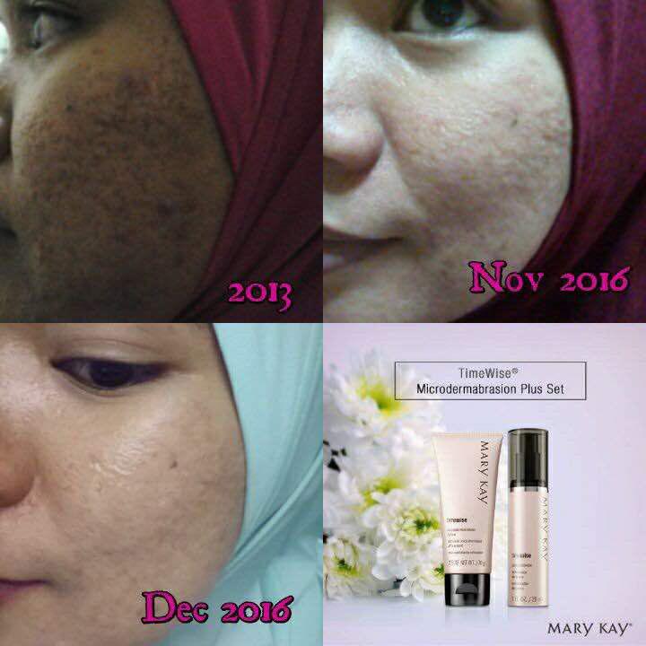 Mary Kay TimeWise Microdermabrasion Set Testimoni dan Review
