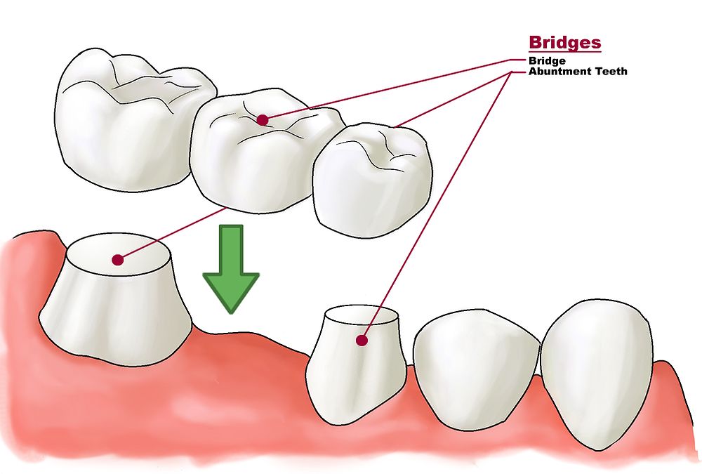 What are dental bridges (Fixed partial dentures) Directorio Odontológico