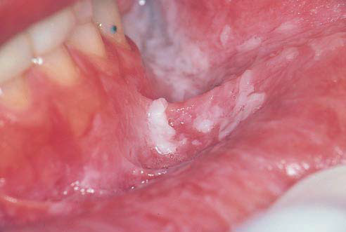 Diffuse White Oral Plaques - Oxford Journals