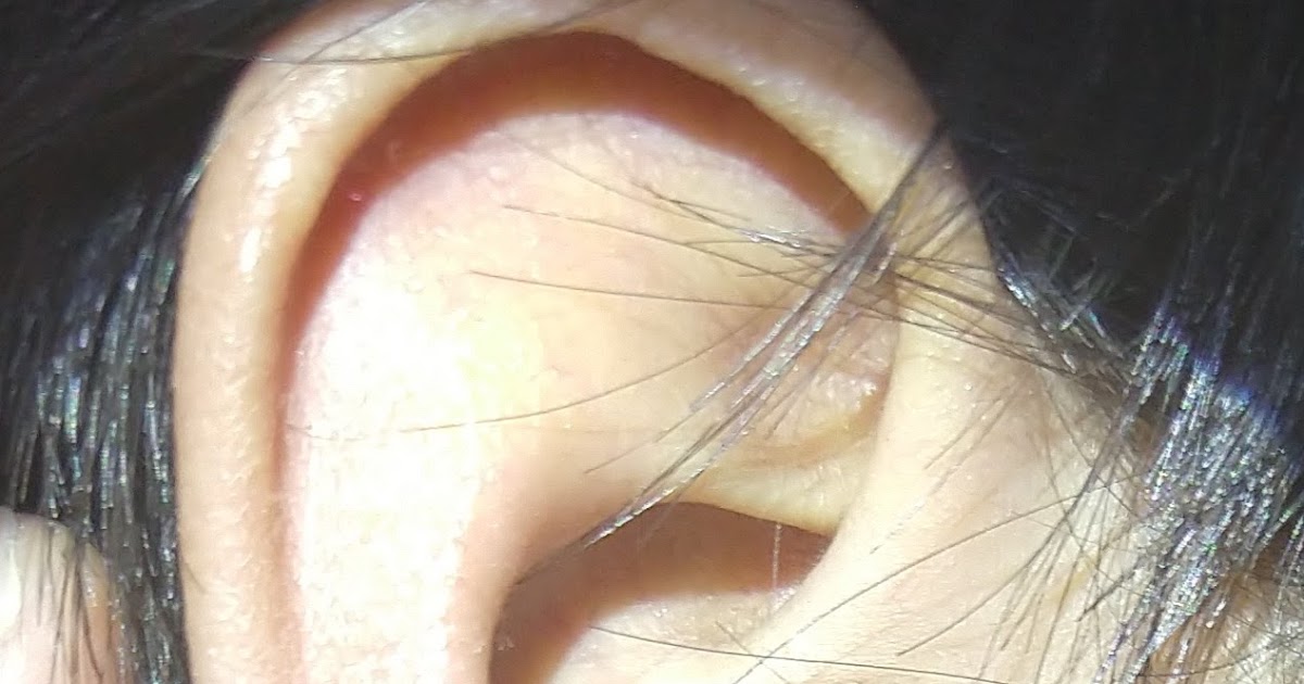 ENT Surgeon's blog Ear Bud related injury in the ear.