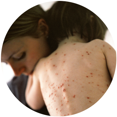 chickenpox in heat, Health:  How to Cope with Chickenpox in a Heatwave (Plus a Chance to Win a ViraSoothe Goodybag)