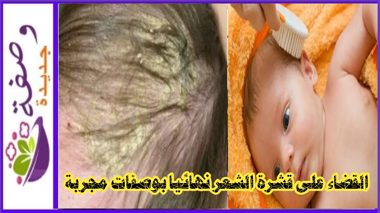القضاء على قشرة الشعر نهائيا بوصفات مجربة