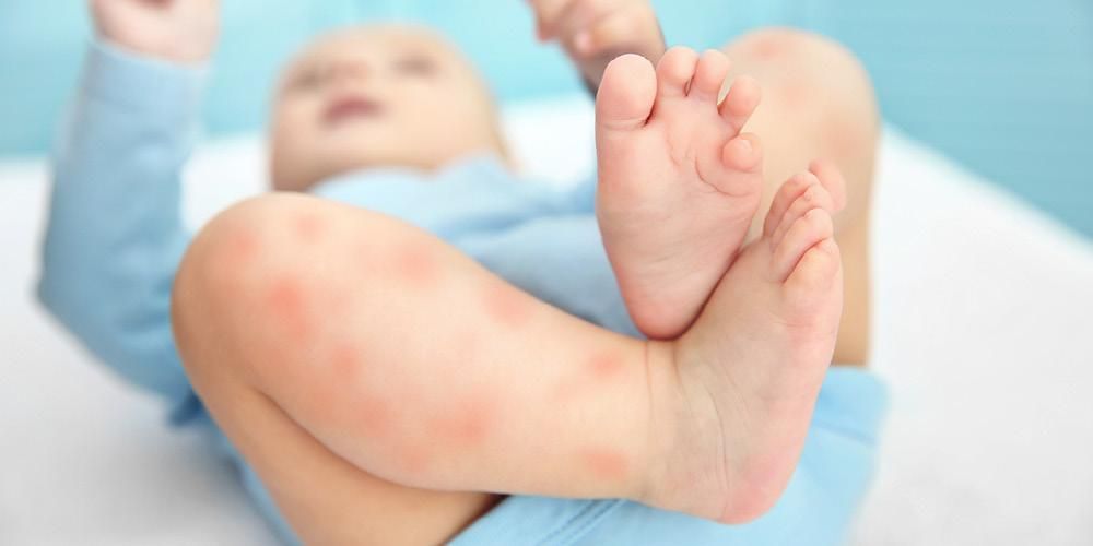 7 types of skin diseases in infants often attack Easy Heal