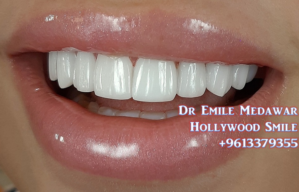 EMax Veneer, Dr Emile Medawar, 00 961 3 379355 Porcelain Veneers, EMax Veneers, Composite