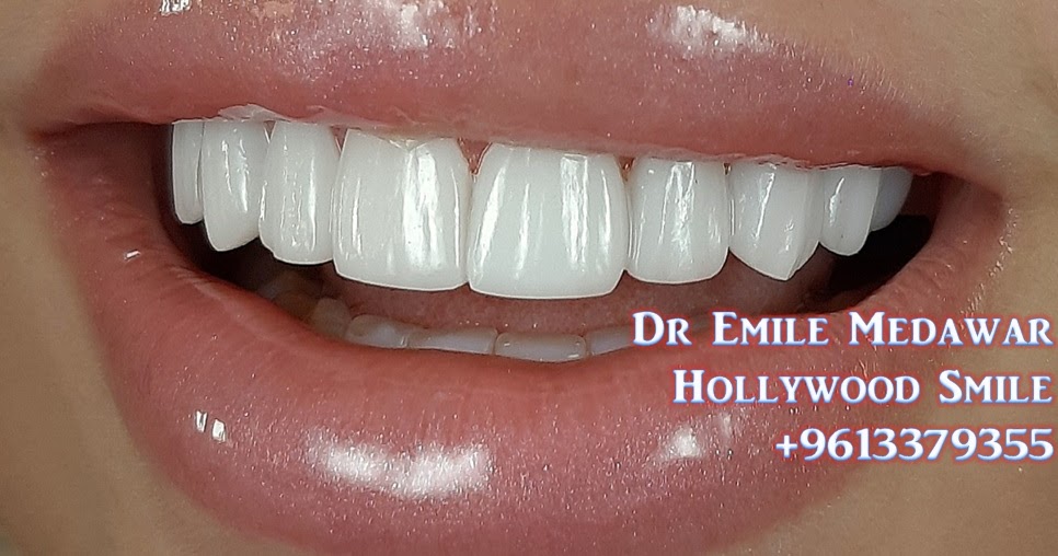 EMax Veneer, Dr Emile Medawar, 00 961 3 379355 Porcelain Veneers, E