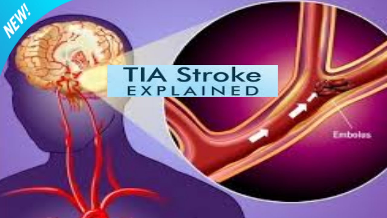 Transient Ischemic Attack (TIA){A to Z informations} Health Physician