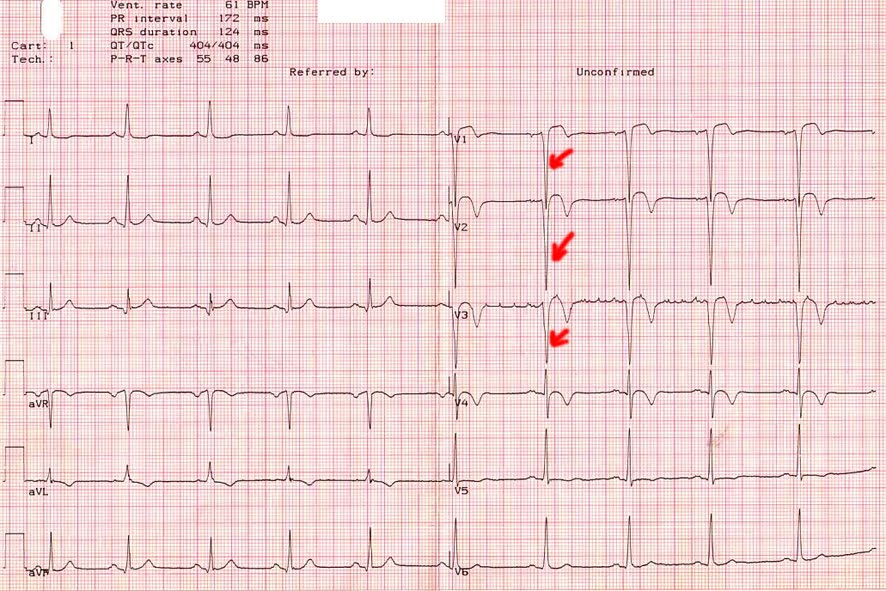 Экг со скольки. Расшифровка ЭКГ инфаркт миокарда инфаркт. Острый и подострый инфаркт миокарда ЭКГ. Подострая стадия инфаркта на ЭКГ. Передне-перегородочный инфаркт миокарда на ЭКГ.