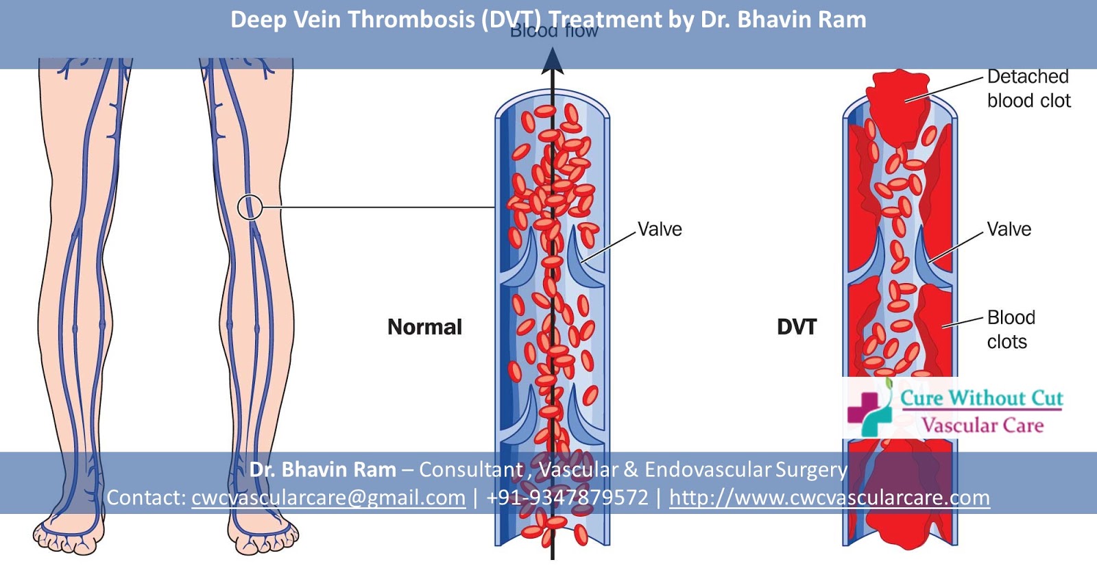 Deep vein thrombosis (DVT) can cause serious problems with the