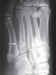 left foot 4th metatarsal fracture left foot 4th metatarsal fracture