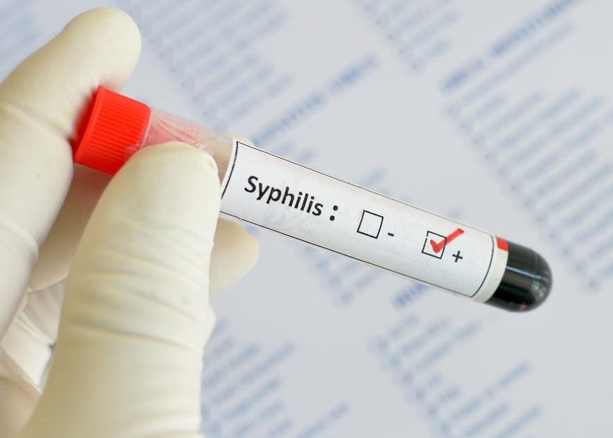 Same Day STD Testing Treatment Syphilis Blood Test in Arlington, VA Watch Out For That Sore or