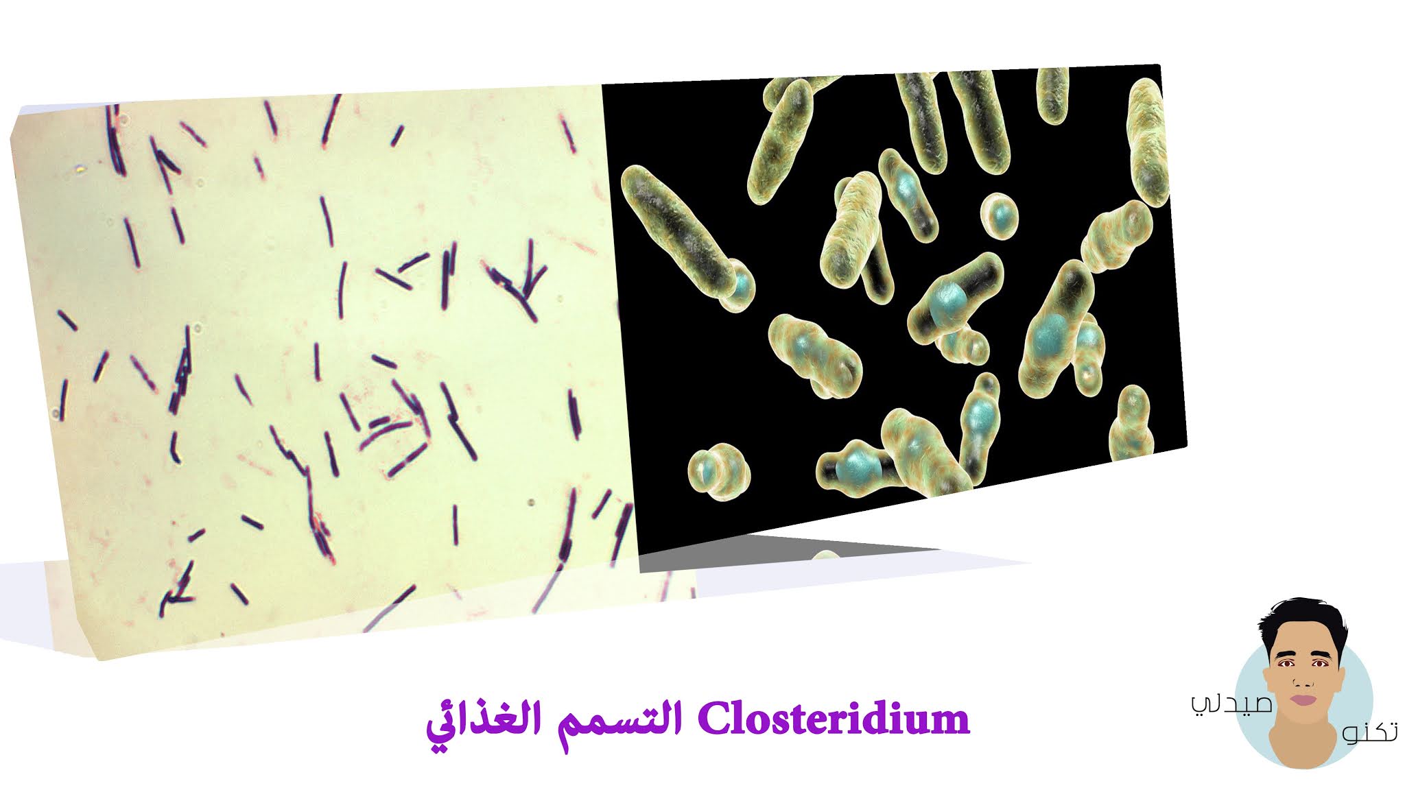 التسمم الغذائي Closteridium