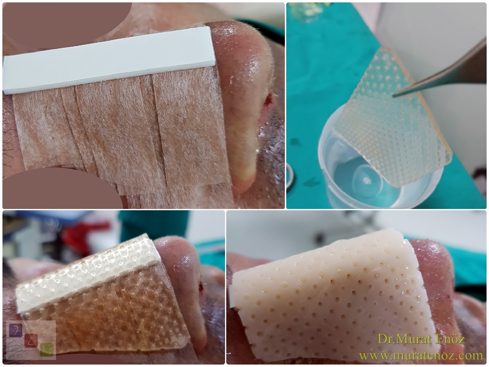 How to Place Thermoplastic Splint on Nose After Rhinoplasty Operation