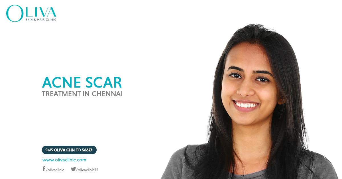 Acne Scar Treatment in Chennai Pimple Marks Treatment in Chennai Oliva Clinics Oliva