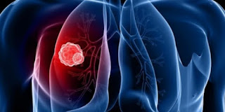 Symptoms Of Lung Cancer That You Should Not Overlook: