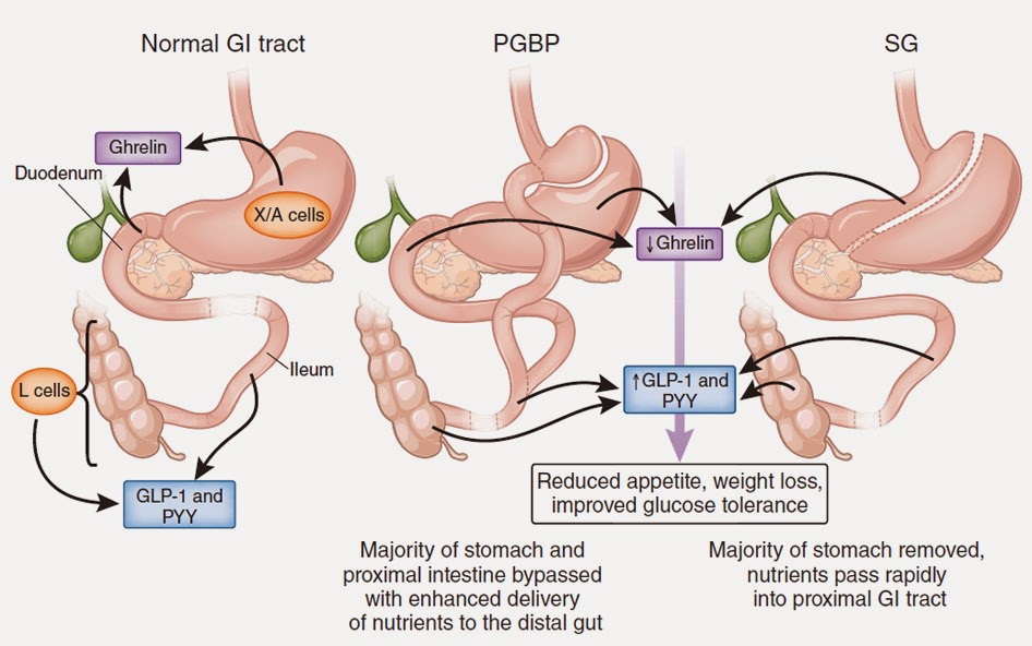 Dr. Amar V SLEEVE vs BYPASS vs GHRELIN