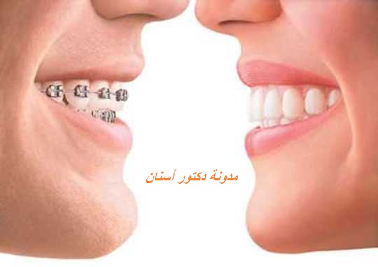 مقارنة بين تقويم الأسنان الشفاف وتقويم الأسنان العادي دكتور أسنان