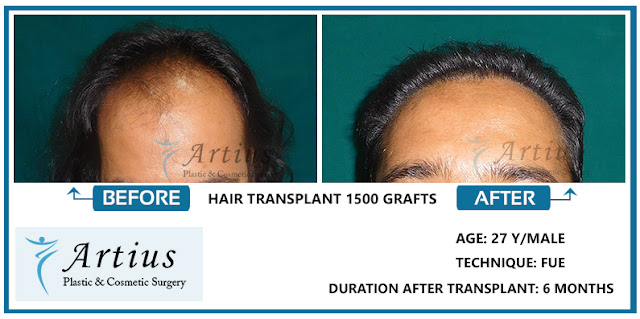 Hair Transplant in Navi Mumbai Hair Transplant in Navi Mumbai
