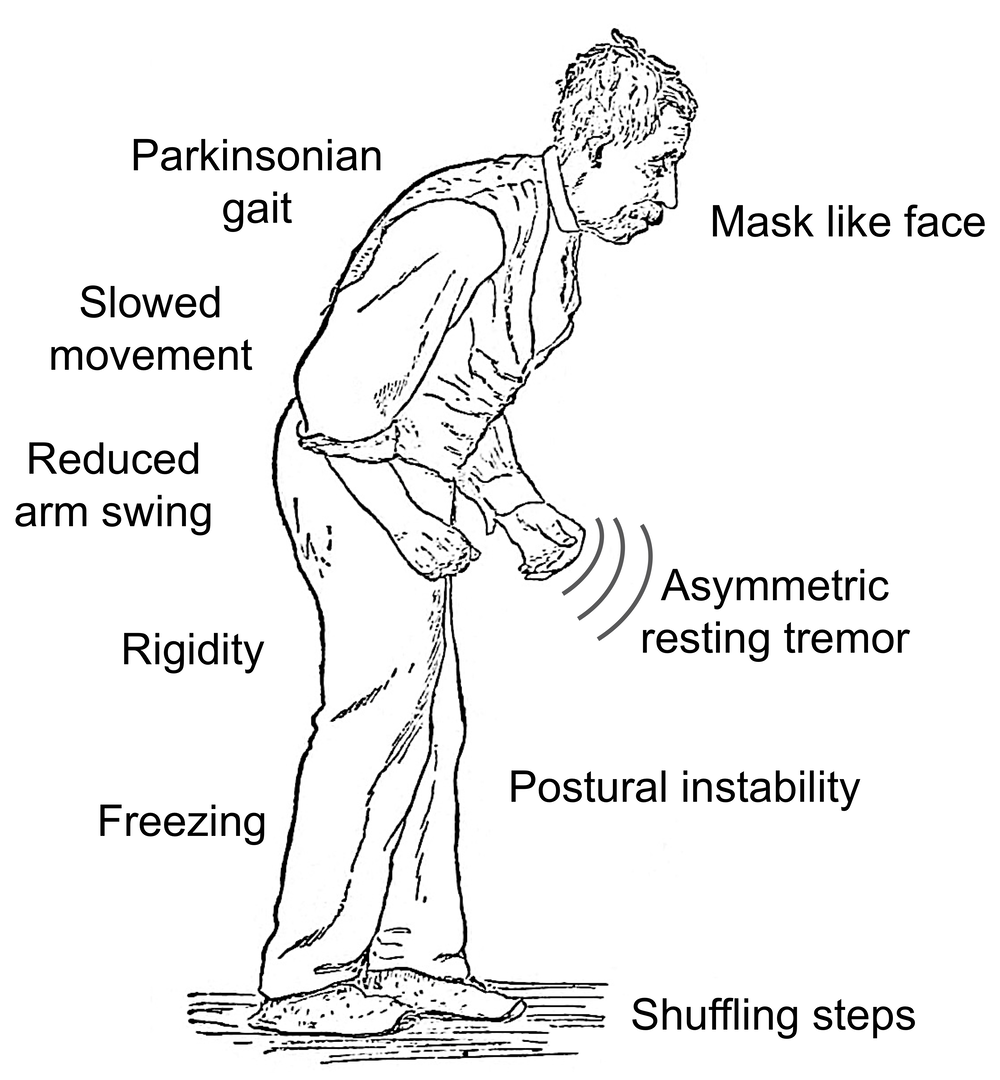 Parkinson Disease